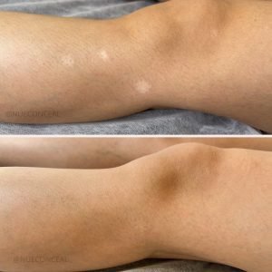 Medical Tattooing for Vitiligo london