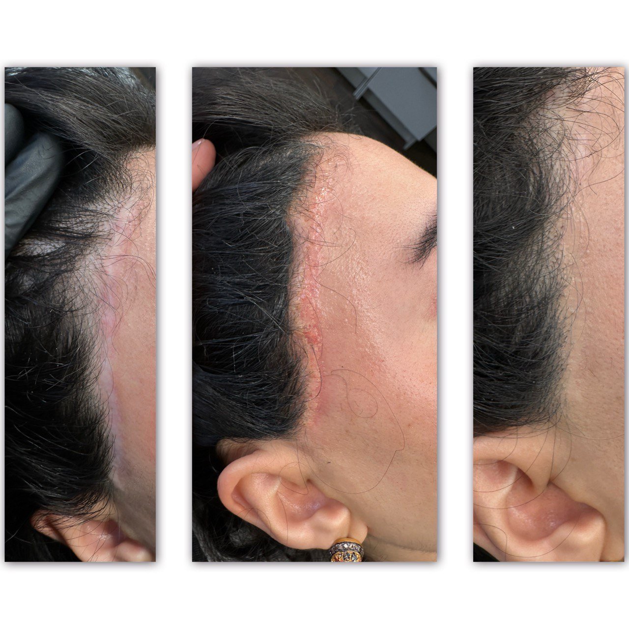 Stretch Marks and Scar Revision Course for Nurses and Doctors : £2000 - Image 2