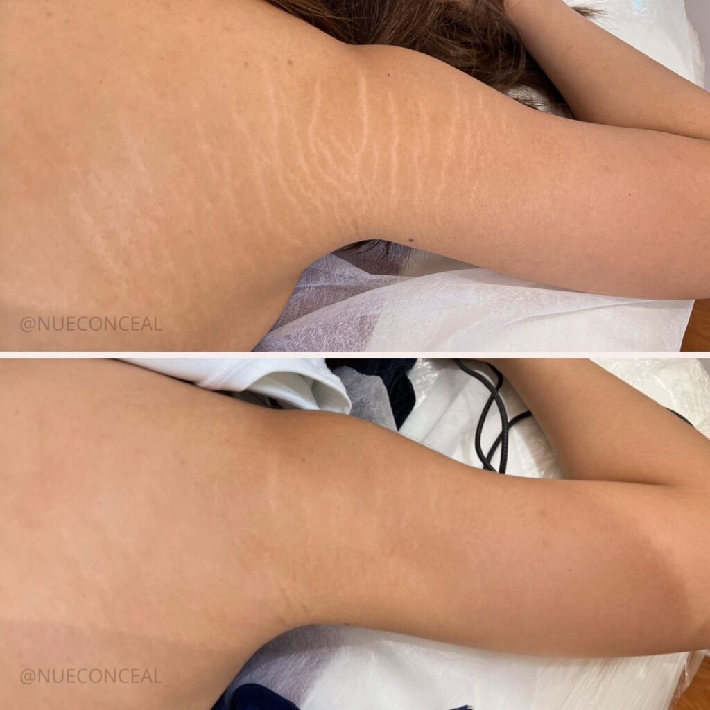 Stretchmark Camouflage