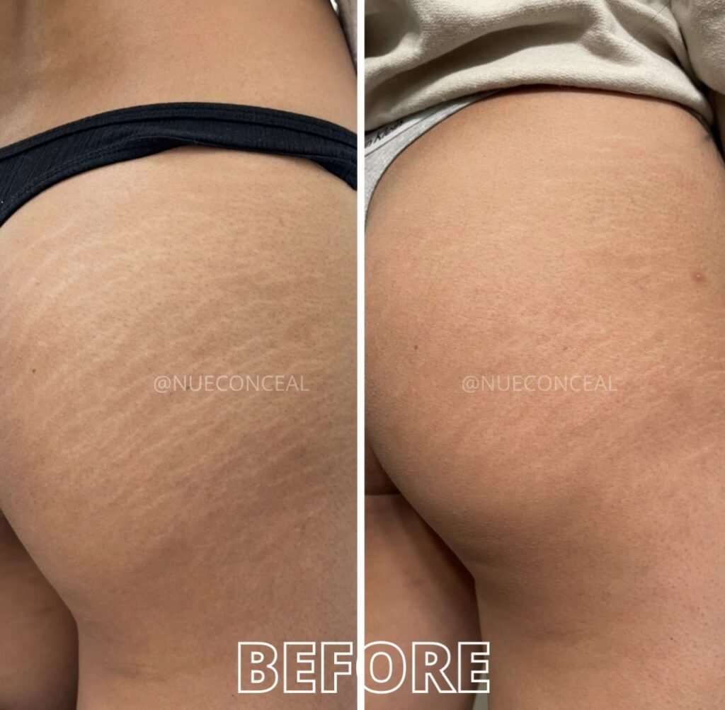 Stretchmark Camouflage london